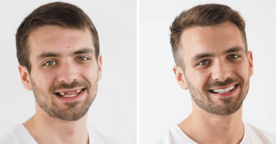 U Hrvatskoj započinje najpoznatiji dentalni makeover! Prijavite se i vi! prije-poslije 2