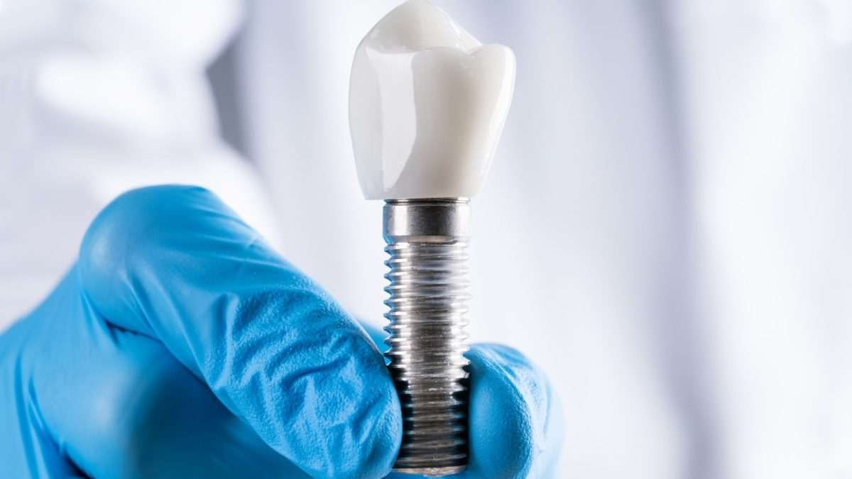 Zubni implantat/Foto: Dentico